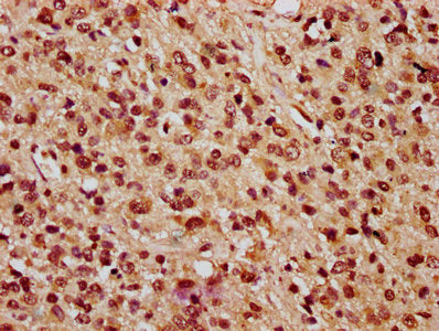IHC image of PARP3 Antibody diluted at 1:100 and staining in paraffin-embedded human glioma performed on a Leica BondTM system. After dewaxing and hydration, antigen retrieval was mediated by high pressure in a citrate buffer (pH 6.0). Section was blocked with 10% normal goat serum 30min at RT. Then primary antibody (1% BSA) was incubated at 4°C overnight. The primary is detected by a biotinylated secondary antibody and visualized using an HRP conjugated SP system.Rabbit anti-Human PARP3 Polyclonal Antibody