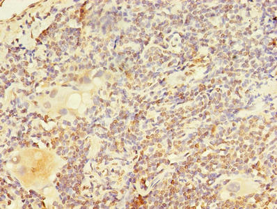 Immunohistochemistry of paraffin-embedded human lung cancer using PAX3 Antibody at dilution of 1:100Rabbit anti-Human PAX3 Polyclonal Antibody