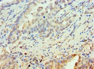 Immunohistochemistry of paraffin-embedded human lung cancer using PAX6 Antibody at dilution of 1:100Rabbit anti-Human PAX6 Polyclonal Antibody