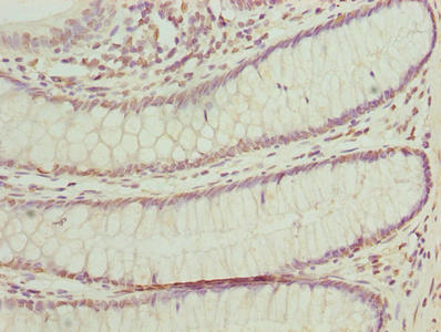 Immunohistochemistry of paraffin-embedded human colon cancer using BUD31 Antibody at dilution of 1:100