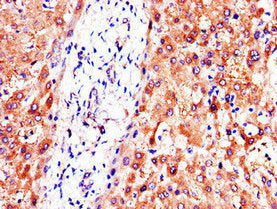 Immunohistochemistry of paraffin-embedded human liver tissue using PC Antibody at dilution of 1:100Rabbit anti-Human PC Polyclonal Antibody