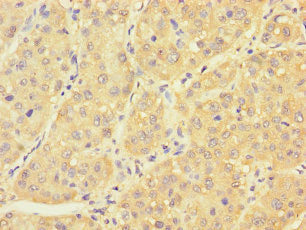 Immunohistochemistry of paraffin-embedded human liver cancer using PCBD1 Antibody at dilution of 1:100Rabbit anti-Human PCBD1 Polyclonal Antibody