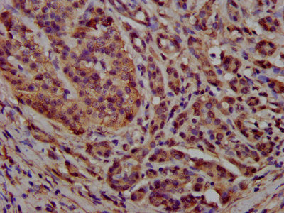 IHC image of PCCB Antibody diluted at 1:300 and staining in paraffin-embedded human pancreatic cancer performed on a Leica BondTM system. After dewaxing and hydration, antigen retrieval was mediated by high pressure in a citrate buffer (pH 6.0). Section was blocked with 10% normal goat serum 30min at RT. Then primary antibody (1% BSA) was incubated at 4°C overnight. The primary is detected by a biotinylated secondary antibody and visualized using an HRP conjugated SP system.Rabbit anti-Human PCCB Polyclonal Antibody