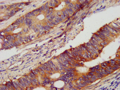 IHC image of PCSK2 Antibody diluted at 1:400 and staining in paraffin-embedded human colon cancer performed on a Leica BondTM system. After dewaxing and hydration, antigen retrieval was mediated by high pressure in a citrate buffer (pH 6.0). Section was blocked with 10% normal goat serum 30min at RT. Then primary antibody (1% BSA) was incubated at 4°C overnight. The primary is detected by a biotinylated secondary antibody and visualized using an HRP conjugated SP system.Rabbit anti-Human PCSK2 Polyclonal Antibody