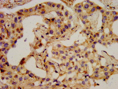 IHC image of PCSK2 Antibody diluted at 1:400 and staining in paraffin-embedded human liver cancer performed on a Leica BondTM system. After dewaxing and hydration, antigen retrieval was mediated by high pressure in a citrate buffer (pH 6.0). Section was blocked with 10% normal goat serum 30min at RT. Then primary antibody (1% BSA) was incubated at 4°C overnight. The primary is detected by a biotinylated secondary antibody and visualized using an HRP conjugated SP system.Rabbit anti-Human PCSK2 Polyclonal Antibody