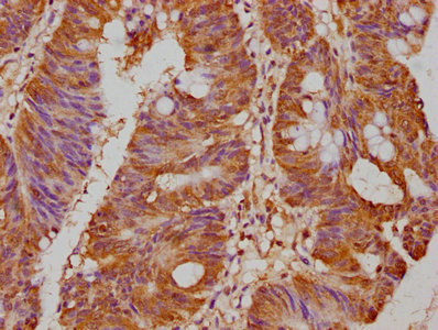 IHC image of the antibody diluted at 1:500 and staining in paraffin-embedded human colon cancer performed on a Leica BondTM system. After dewaxing and hydration, antigen retrieval was mediated by high pressure in a citrate buffer (pH 6.0). Section was blocked with 10% normal goat serum 30min at RT. Then primary antibody (1% BSA) was incubated at 4°C overnight. The primary is detected by a biotinylated secondary antibody and visualized using an HRP conjugated SP system.Rabbit anti-Human PCSK9 Polyclonal Antibody