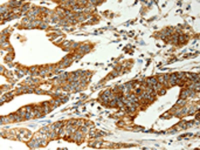The image on the left is immunohistochemistry of paraffin-embedded Human gastic cancer tissue using COX7B Antibody(COX7B Antibody) at dilution 1/70, on the right is treated with fusion protein. (Original magnification: ×200)Rabbit anti-Human COX7B Polyclonal Antibody