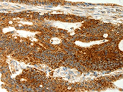 The image on the left is immunohistochemistry of paraffin-embedded Human colon cancer tissue using the antibody Antibody) at dilution 1/70, on the right is treated with fusion protein. (Original magnification: ×200)Rabbit anti-Human COX7B Polyclonal Antibody