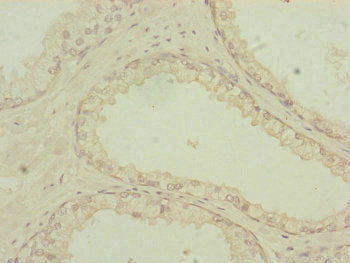 Immunohistochemistry of paraffin-embedded human prostate cancer using PDHA2 Antibody at dilution of 1:100Rabbit anti-Human PDHA2 Polyclonal Antibody