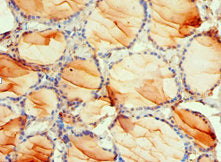 Immunohistochemistry of paraffin-embedded human thyroid tissue using the antibody at dilution of 1:100Rabbit anti-Human PDPK1 Polyclonal Antibody