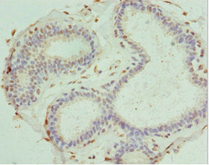 Immunohistochemistry of paraffin-embedded human breast cancer using PDXK Antibody at dilution of 1:100Rabbit anti-Human PDXK Polyclonal Antibody