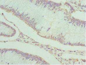Immunohistochemistry of paraffin-embedded human colon cancer using PDXK Antibody at dilution of 1:100Rabbit anti-Human PDXK Polyclonal Antibody