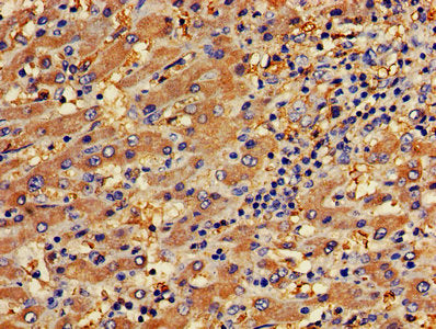 IHC image of PECAM1 Antibody diluted at 1:400 and staining in paraffin-embedded human liver cancer performed on a Leica BondTM system. After dewaxing and hydration, antigen retrieval was mediated by high pressure in a citrate buffer (pH 6.0). Section was blocked with 10% normal goat serum 30min at RT. Then primary antibody (1% BSA) was incubated at 4°C overnight. The primary is detected by a biotinylated secondary antibody and visualized using an HRP conjugated SP system.Rabbit anti-Human PECAM1 Polyclonal Antibody
