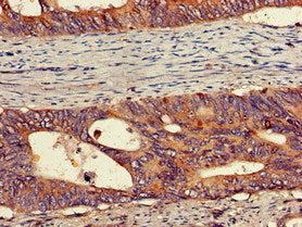 Immunohistochemistry of paraffin-embedded human colon cancer using PEPD Antibody at dilution of 1:100Rabbit anti-Human PEPD Polyclonal Antibody