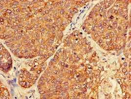Immunohistochemistry of paraffin-embedded human ovarian cancer using PER3 Antibody at dilution of 1:100Rabbit anti-Human PER3 Polyclonal Antibody