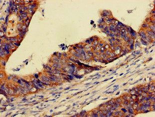 Immunohistochemistry of paraffin-embedded human colon cancer using PER3 Antibody at dilution of 1:100Rabbit anti-Human PER3 Polyclonal Antibody