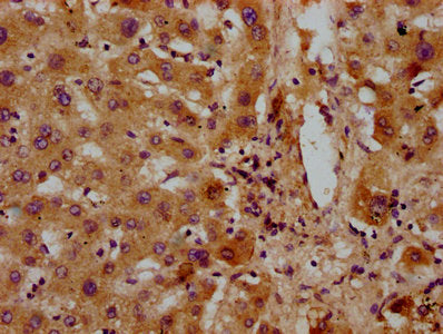 IHC image of GATB Antibody diluted at 1:300 and staining in paraffin-embedded human liver tissue performed on a Leica BondTM system. After dewaxing and hydration, antigen retrieval was mediated by high pressure in a citrate buffer (pH 6.0). Section was blocked with 10% normal goat serum 30min at RT. Then primary antibody (1% BSA) was incubated at 4°C overnight. The primary is detected by a biotinylated secondary antibody and visualized using an HRP conjugated SP system.Rabbit anti-Human GATB Polyclonal Antibody