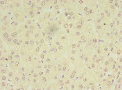 Immunohistochemistry of paraffin-embedded human liver cancer using PEX11B Antibody at dilution of 1:100Rabbit anti-Human PEX11B Polyclonal Antibody