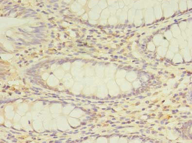 Immunohistochemistry of paraffin-embedded human colon cancer using PEX11B Antibody at dilution of 1:100Rabbit anti-Human PEX11B Polyclonal Antibody