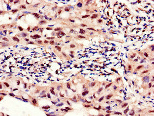 Immunohistochemistry of paraffin-embedded human lung cancer using the antibody at dilution of 1:100Rabbit anti-Human PFKFB2 Polyclonal Antibody