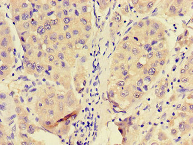 Immunohistochemistry of paraffin-embedded human liver cancer using PFKL Antibody at dilution of 1:100Rabbit anti-Human PFKL Polyclonal Antibody