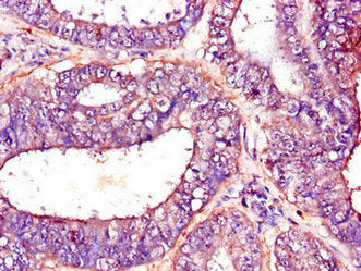 Immunohistochemistry of paraffin-embedded human endometrial cancer using PFKM Antibody at dilution of 1:100Rabbit anti-Human PFKM Polyclonal Antibody