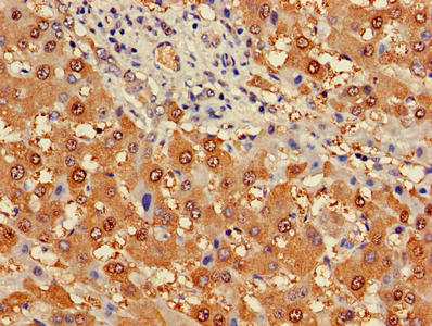 Immunohistochemistry of paraffin-embedded human liver cancer using PGM1 Antibody at dilution of 1:100Rabbit anti-Human PGM1 Polyclonal Antibody