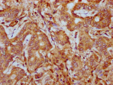 IHC image of PHACTR1 Antibody diluted at 1:400 and staining in paraffin-embedded human liver cancer performed on a Leica BondTM system. After dewaxing and hydration, antigen retrieval was mediated by high pressure in a citrate buffer (pH 6.0). Section was blocked with 10% normal goat serum 30min at RT. Then primary antibody (1% BSA) was incubated at 4°C overnight. The primary is detected by a biotinylated secondary antibody and visualized using an HRP conjugated SP system.Rabbit anti-Human PHACTR1 Polyclonal Antibody