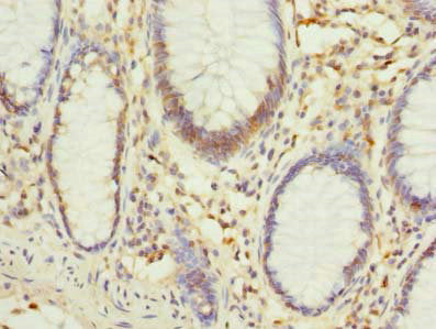 Immunohistochemistry of paraffin-embedded human colon cancer using PHF10 Antibody at dilution of 1:100Rabbit anti-Human PHF10 Polyclonal Antibody