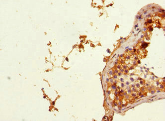 Immunohistochemistry of paraffin-embedded human testis tissue using PHF11 Antibody at dilution of 1:100Rabbit anti-Human PHF11 Polyclonal Antibody