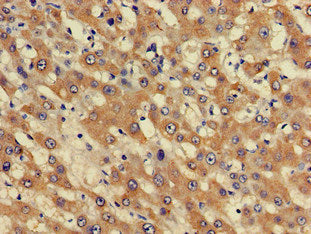 Immunohistochemistry of paraffin-embedded human liver cancer using PHF21A Antibody at dilution of 1:100Rabbit anti-Human PHF21A Polyclonal Antibody