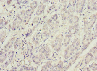 Immunohistochemistry of paraffin-embedded human liver cancer using PHKG2 Antibody at dilution of 1:100Rabbit anti-Human PHKG2 Polyclonal Antibody