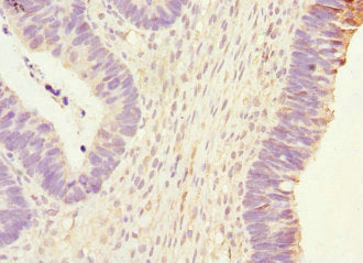 Immunohistochemistry of paraffin-embedded human ovarian cancer using PHKG2 Antibody at dilution of 1:100Rabbit anti-Human PHKG2 Polyclonal Antibody