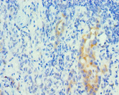 Immunohistochemistry of paraffin-embedded human lung cancer using PIAS1 Antibody at dilution of 1:100Rabbit anti-Human PIAS1 Polyclonal Antibody