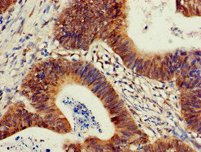 Immunohistochemistry of paraffin-embedded human colon cancer using PIK3R2 Antibody at dilution of 1:100Rabbit anti-Human PIK3R2 Polyclonal Antibody