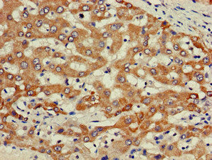 Immunohistochemistry of paraffin-embedded human liver cancer using PIK3R2 Antibody at dilution of 1:100Rabbit anti-Human PIK3R2 Polyclonal Antibody