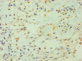 Immunohistochemistry of paraffin-embedded human breast cancer using PIP4K2B Antibody at dilution of 1:100Rabbit anti-Human PIP4K2B Polyclonal Antibody