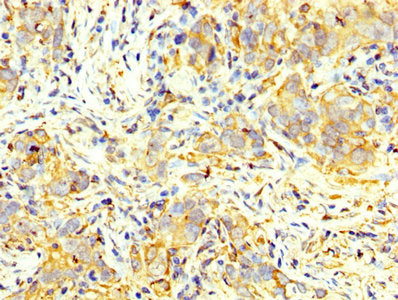 IHC image of PKM Antibody diluted at 1:400 and staining in paraffin-embedded human pancreatic cancer performed on a Leica BondTM system. After dewaxing and hydration, antigen retrieval was mediated by high pressure in a citrate buffer (pH 6.0). Section was blocked with 10% normal goat serum 30min at RT. Then primary antibody (1% BSA) was incubated at 4°C overnight. The primary is detected by a biotinylated secondary antibody and visualized using an HRP conjugated SP system.Rabbit anti-Human PKM Polyclonal Antibody