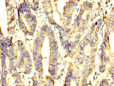 IHC image of PKM Antibody diluted at 1:400 and staining in paraffin-embedded human colon cancer performed on a Leica BondTM system. After dewaxing and hydration, antigen retrieval was mediated by high pressure in a citrate buffer (pH 6.0). Section was blocked with 10% normal goat serum 30min at RT. Then primary antibody (1% BSA) was incubated at 4°C overnight. The primary is detected by a biotinylated secondary antibody and visualized using an HRP conjugated SP system.Rabbit anti-Human PKM Polyclonal Antibody