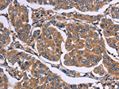 The image on the left is immunohistochemistry of paraffin-embedded Human breast cancer tissue using the antibody Antibody) at dilution 1/20, on the right is treated with synthetic peptide. (Original magnification: ×200)Rabbit anti-Human EGR4 Polyclonal Antibody