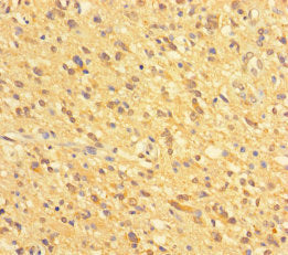 Immunohistochemistry of paraffin-embedded human glioma using GATD3A Antibody at dilution of 1:100Rabbit anti-Human GATD3A Polyclonal Antibody