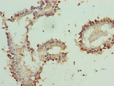 Immunohistochemistry of paraffin-embedded human breast cancer using PLP1 Antibody at dilution of 1:100Rabbit anti-Human PLP1 Polyclonal Antibody