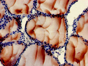 Immunohistochemistry of paraffin-embedded human thyroid tissue using PLS3 Antibody at dilution of 1:100Rabbit anti-Human PLS3 Polyclonal Antibody