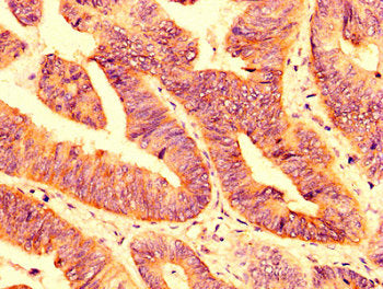IHC image of the antibody diluted at 1:200 and staining in paraffin-embedded human colon cancer performed on a Leica BondTM system. After dewaxing and hydration, antigen retrieval was mediated by high pressure in a citrate buffer (pH 6.0). Section was blocked with 10% normal goat serum 30min at RT. Then primary antibody (1% BSA) was incubated at 4°C overnight. The primary is detected by a biotinylated secondary antibody and visualized using an HRP conjugated SP system.Rabbit anti-Human PLXNB1 Polyclonal Antibody