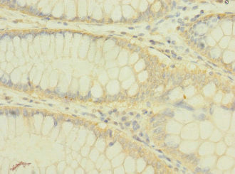 Immunohistochemistry of paraffin-embedded human colon cancer using PLXNB2 Antibody at dilution of 1:100Rabbit anti-Human PLXNB2 Polyclonal Antibody