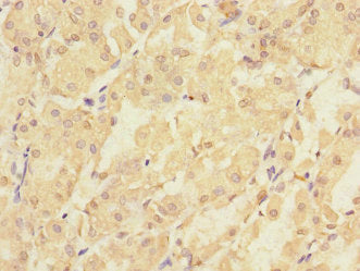 Immunohistochemistry of paraffin-embedded human gastric cancer using PMM2 Antibody at dilution of 1:100Rabbit anti-Human PMM2 Polyclonal Antibody