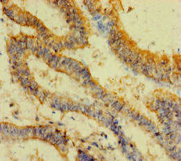 Immunohistochemistry of paraffin-embedded human endometrial cancer using the antibody at dilution of 1:100Rabbit anti-Human FAU Polyclonal Antibody