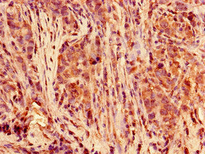 Immunohistochemistry of paraffin-embedded human pancreatic cancer using POLR2C Antibody at dilution of 1:100