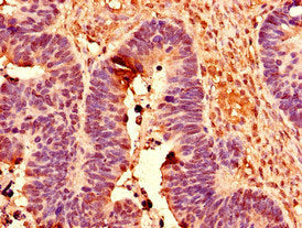 Immunohistochemistry of paraffin-embedded human ovarian cancer using POLR2C Antibody at dilution of 1:100