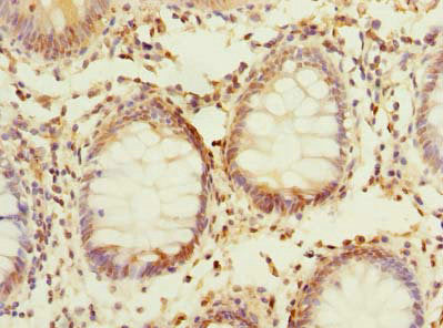 Immunohistochemistry of paraffin-embedded human colon cancer using PLPP2 Antibody at dilution of 1:100Rabbit anti-Human PLPP2 Polyclonal Antibody